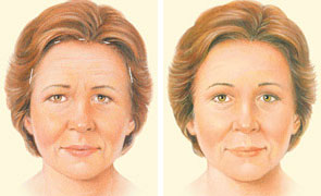 Eyebrow Lifting Surgery Nobel Medical Group